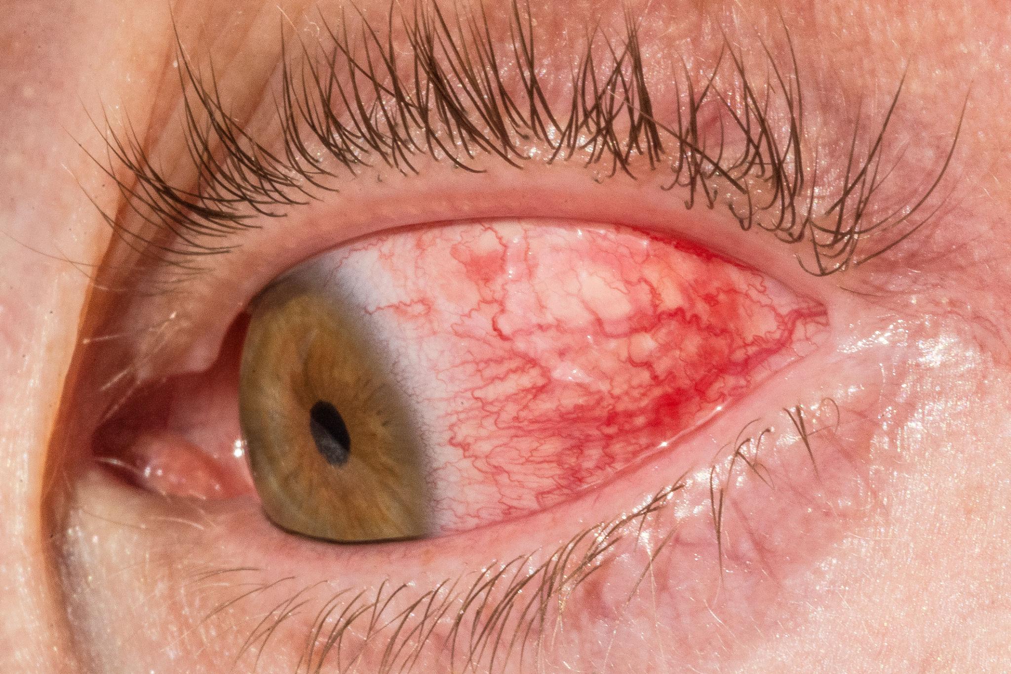 Uvéite : inflammation de l’œil