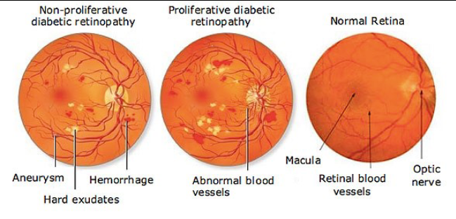 Rétinopathie diabétique : une complication du diabète qui peut toucher les yeux