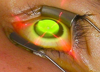 Chirurgie réfractive et kératocône : quelles solutions pour corriger la vision ?